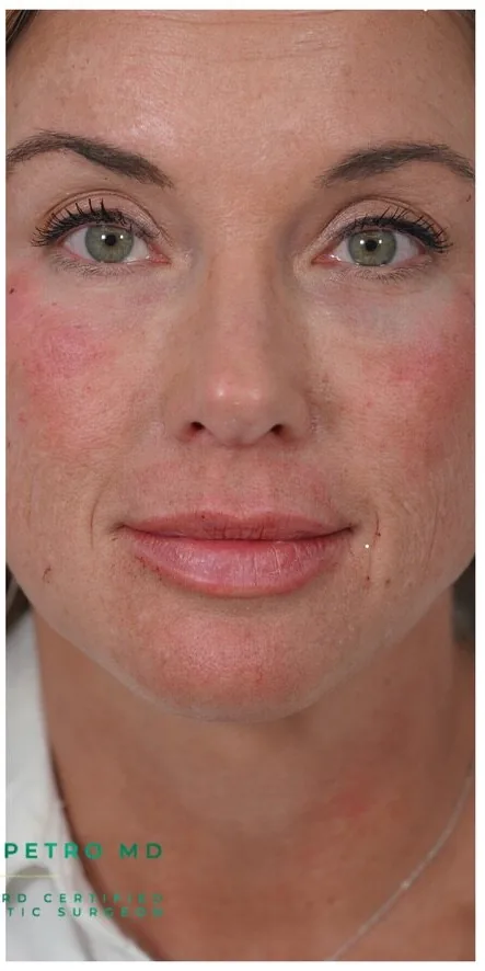 Injectables at Petro Facial Plastic Surgery & Medspa