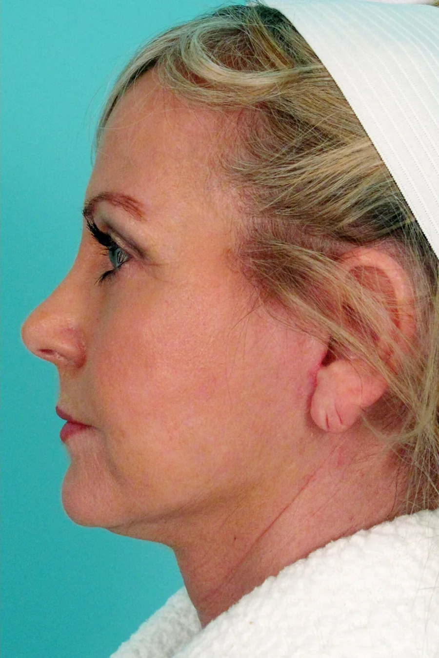 Facial surgery at Petro Facial Plastic Surgery & Medspa